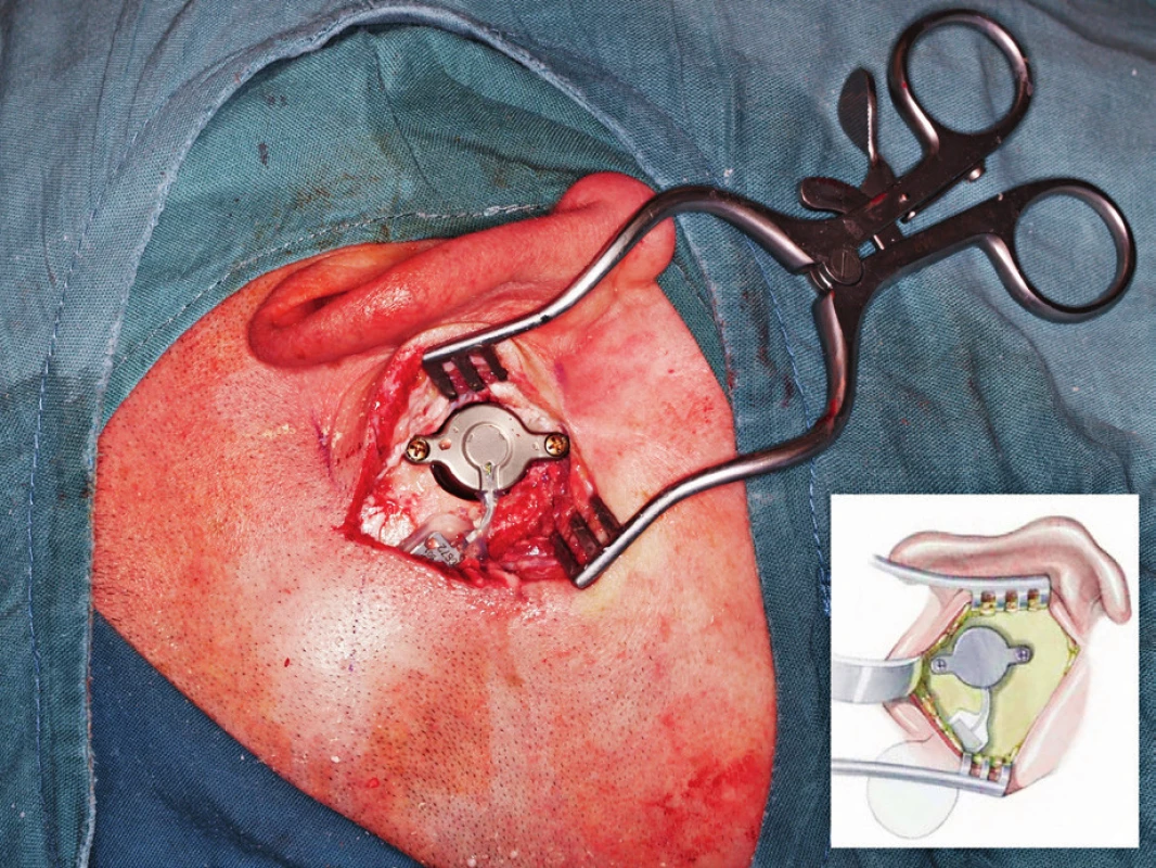 Operace: transmastoidní přístup - finální fáze - cívka
implantabilní části zavedena do podkožní kapsy, transducer uložen
do připraveného kostního lůžka a ukotven dvěma kortikálními
šrouby.