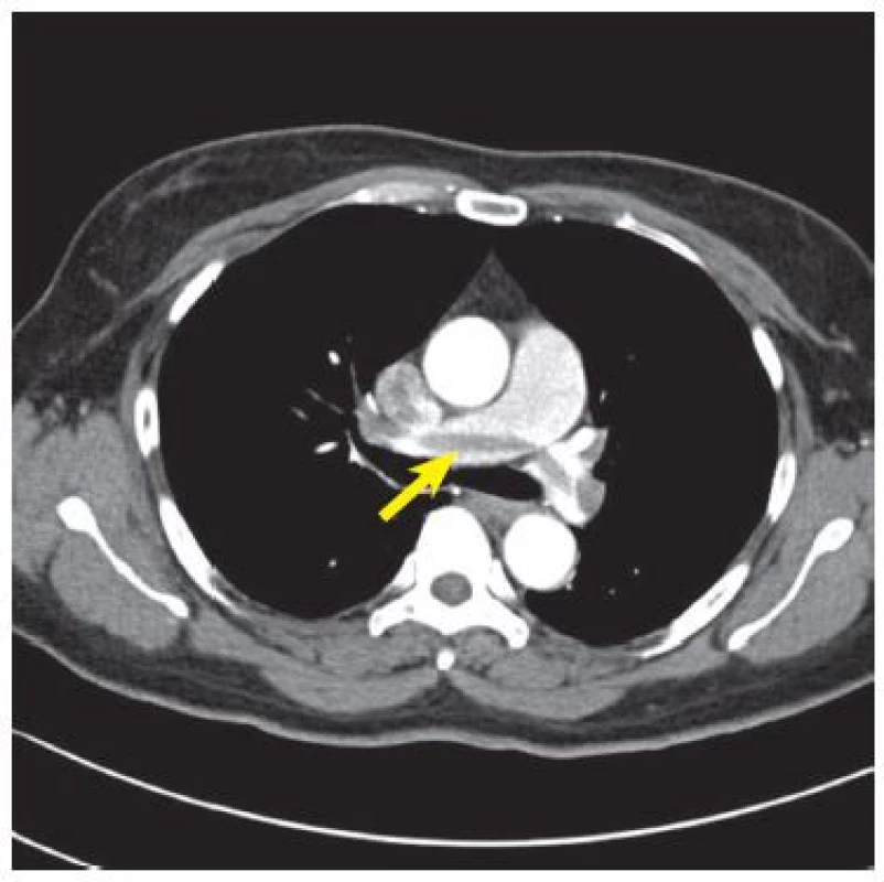 Sedlový trombus. CTPA u pacienta s oboustrannou EP. Uprostřed je patrný sedlový embolus, který obturuje rozvětvení plicní tepny (šipka). Case courtesy of Dr Ian Bickle, Radiopaedia.org, rID: 27993.