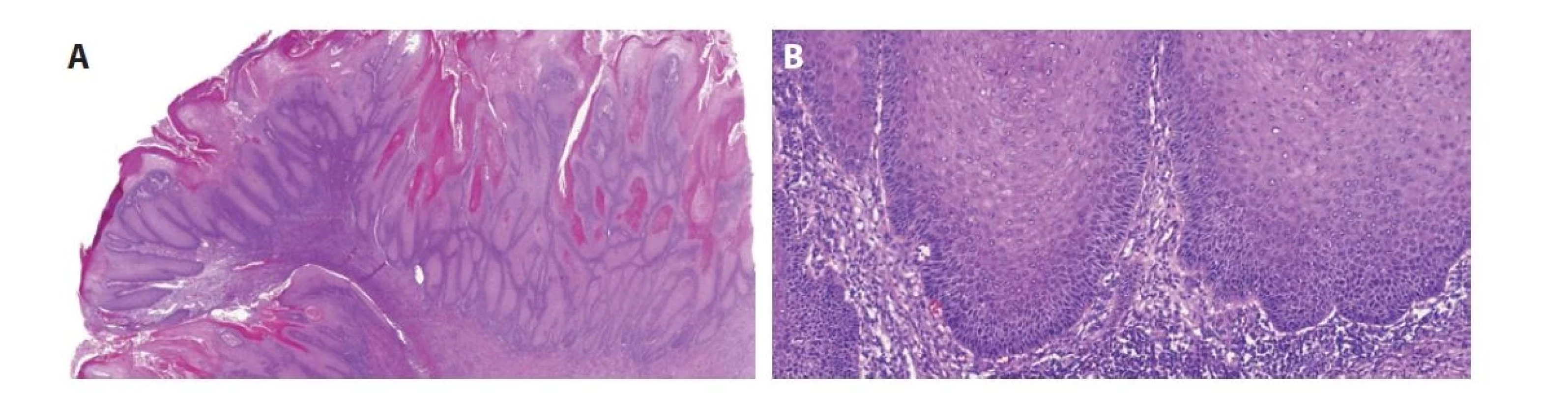 Verukózní karcinom je papilárně rostoucí dobře diferencovaný tumor neinfiltrující do stromatu (vyznačuje se tzv. „pushing pattern of infiltration“)
(A). Tumor nevykazuje výraznější cytologické atypie (B).