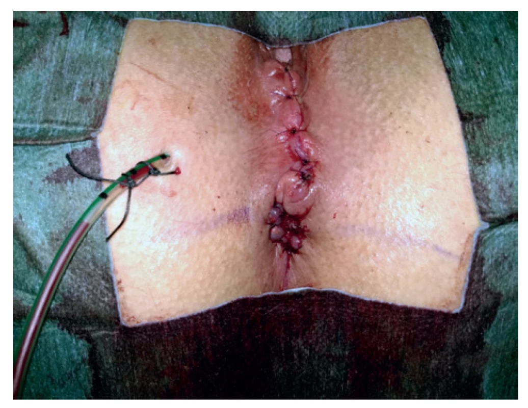 Anokutální anastomóza se zašitým defektem po píštěli<br>
Fig. 5: Anocutaneous anastomosis with the defect from fistula
removal sutured