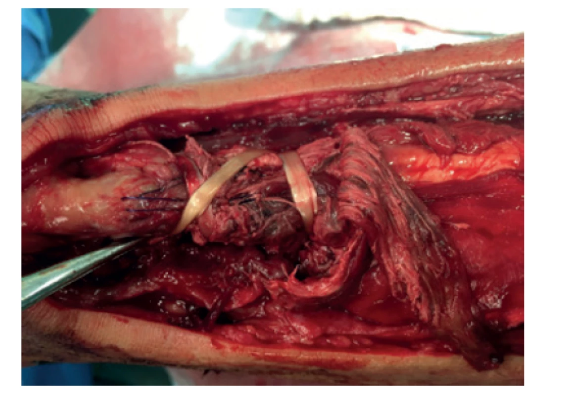 Augmentace sutury šlachou m. plantaris<br>
Fig. 3: Suture augmentation using the plantaris muscle
tendon