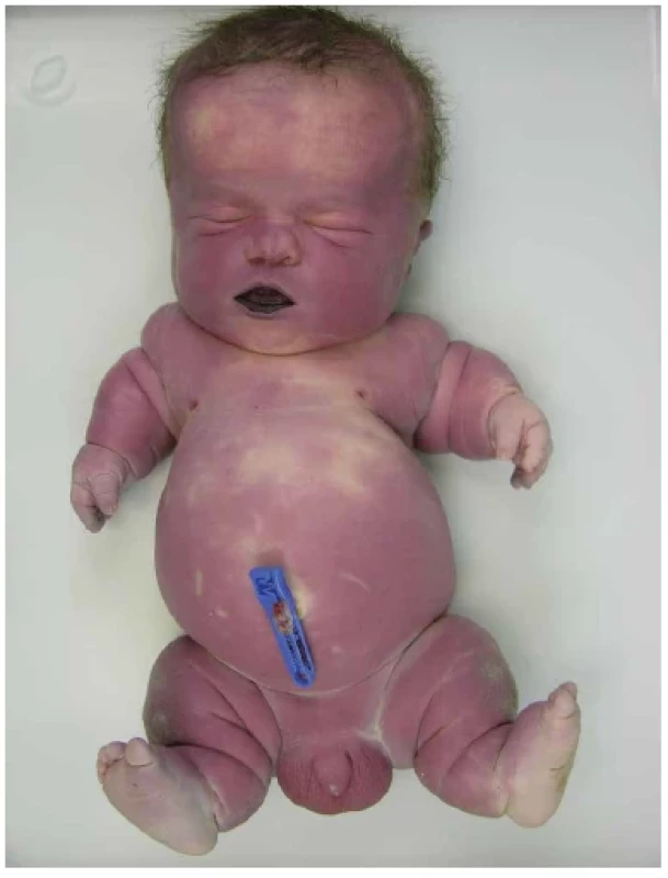 Donošený novorozenec s thanatoforickou dysplázií. Makrocefalie se
širokým klenutým čelem a vkleslým kořenem nosu. Krátký plochý hrudník.
Krátké končetiny s nadbytečnými kožními řasami a brachydaktylií.