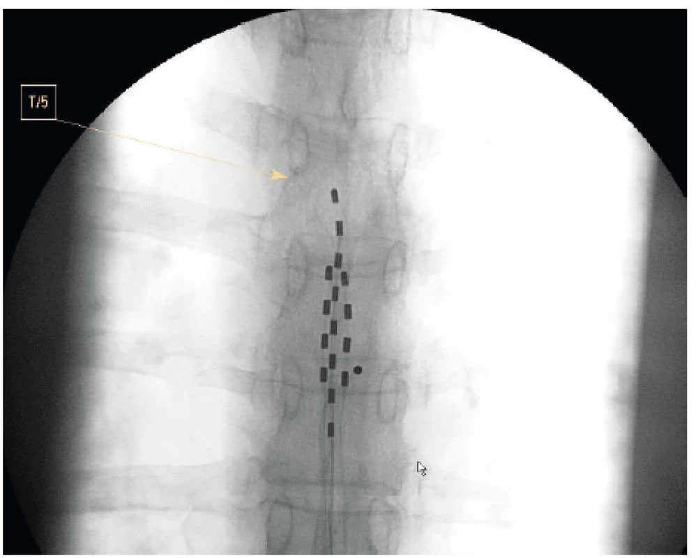 Vícečetné zavedení elektrod pro SCS u viscerální
bolesti