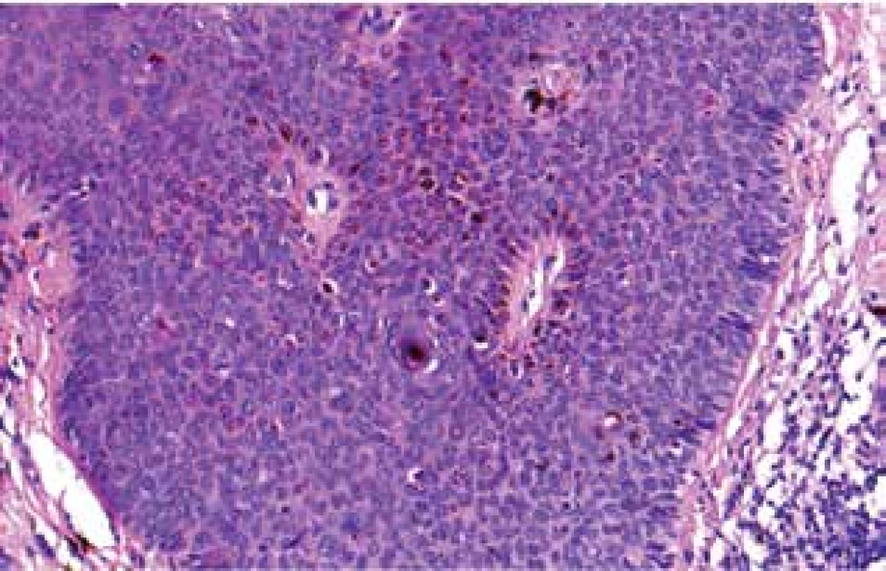 Histologický nález z probatorní excize – dysplastický
epitel, atypické mitózy, množství melaninu v epidermis