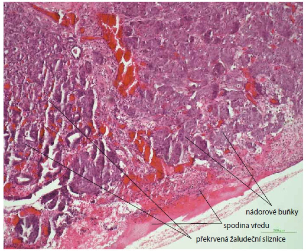 Histologický nález vredu žalúdku s infiltráciou nádorových buniek
(metastáza karcinómu prsníka), farbenie hematoxin-eozinom, zväčšenie 10×.<br>
Fig. 2. Histological image of stomach ulcer with infiltration of tumour cells (breast
carcinoma metastasis), haematoxylin-eosin staining, magnifi cation 10×.