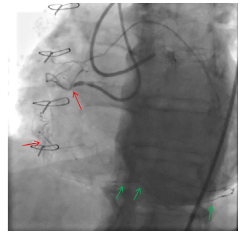 CTO arteria coronaria dextra (ACD) – komplexní nález u pacienta
s uzavřeným žilním bypassem na distální segment ACD; velmi dlouhý
uzávěr s přítomnými kalcifikacemi a tortuozitami v průběhu uzávěru
(J-CTO 3); patrná proximální „cap“ uzávěru a náznak reziduálního lumen
s následným dalším uzávěrem ve střední části tepny (červené šipky), distální
segmenty se plní z kolaterál z levé věnčité tepny (zelené šipky)