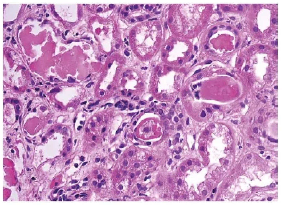 Detail vločkovitých bílkovinných válců v případě tzv. myelomové
ledviny. Barveno hematoxylinem eosinem (zvětšení 400x).