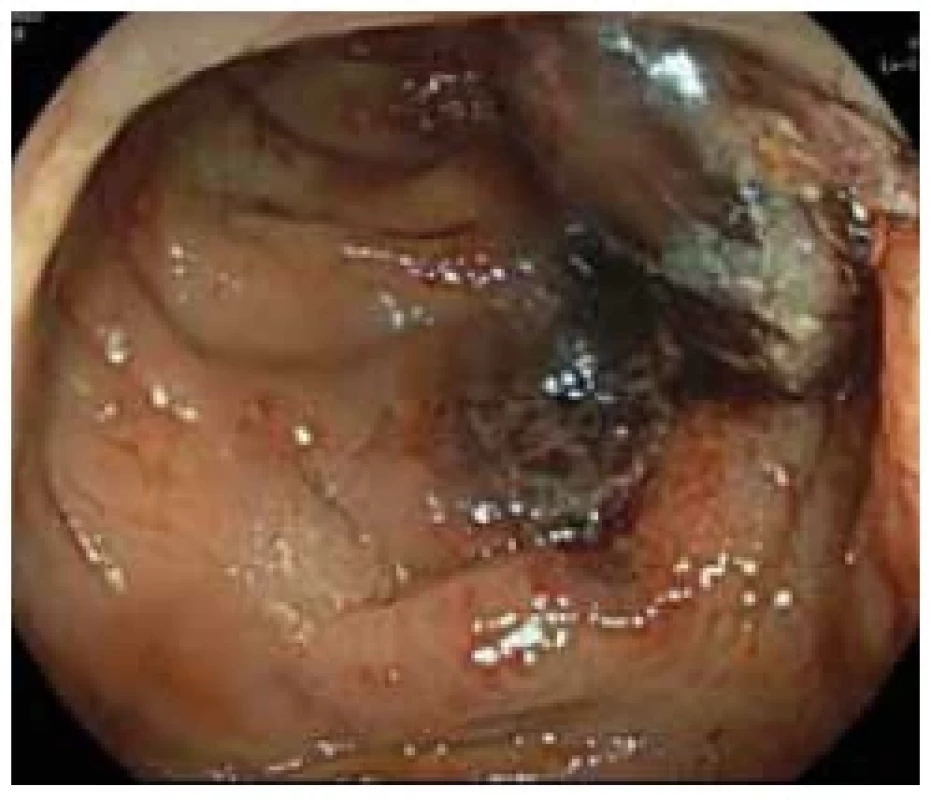 Zánětlivé postižení tlustého
střeva v oblasti sestupného tračníku. <br> 
Fig. 2. Infl ammatory involvement of
the large intestine in the area of the
descending colon.