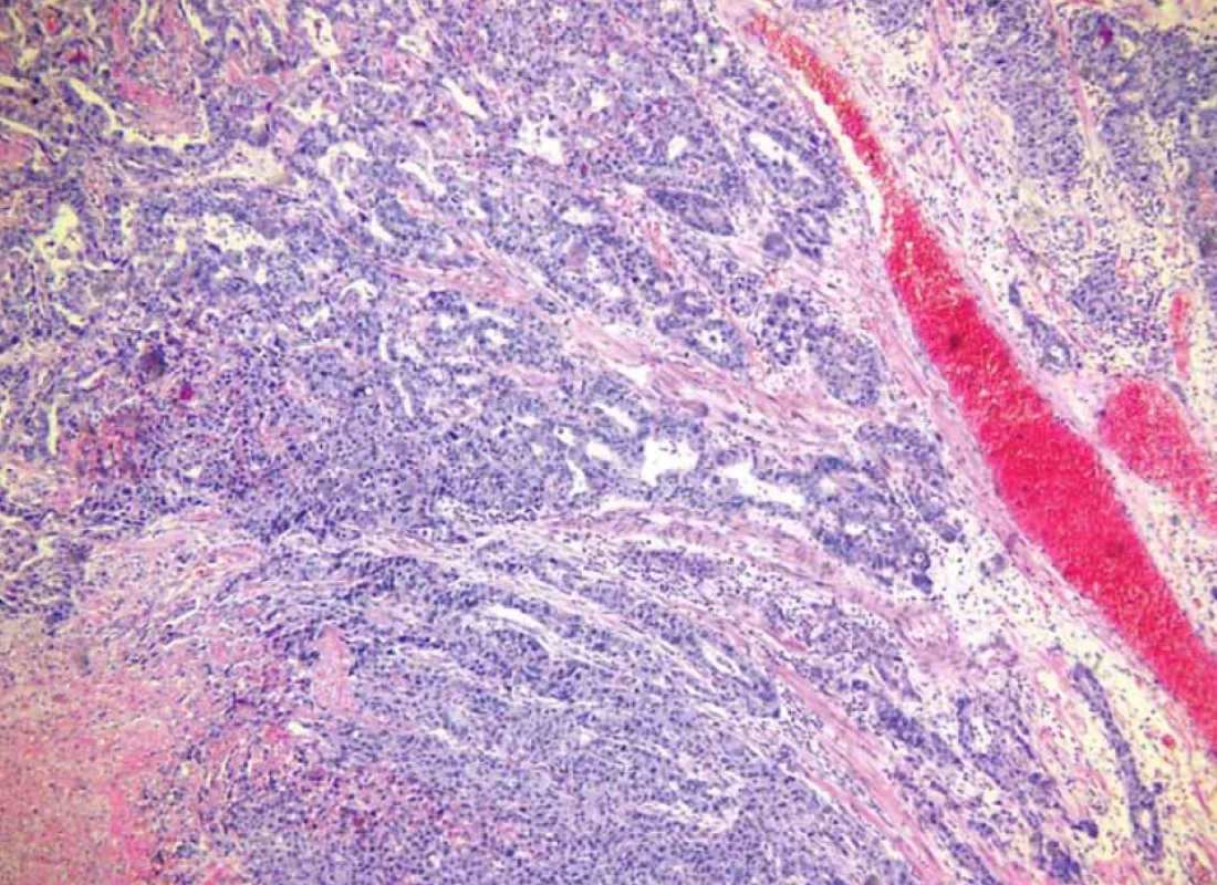 Prakticky v celém zorném poli smíšený adenoneuroendokrinní karcinom, v horní části převažuje žlazová komponenta tumoru s náznaky tvorby tubulárních struktur, v dolní části se nachází solidně rostoucí neuroendokrinní komponenta (barvení hematoxilin-eozin). </br>Fig. 9. Mixed adenoneuroendocrine carcinoma practically in the entire fi eld of view, in the upper part the glandular component of the tumor with signs of the formation of tubular structures predominates, in the lower part there is a solidly growing neuroendocrine component (hematoxylin-eosin staining).
