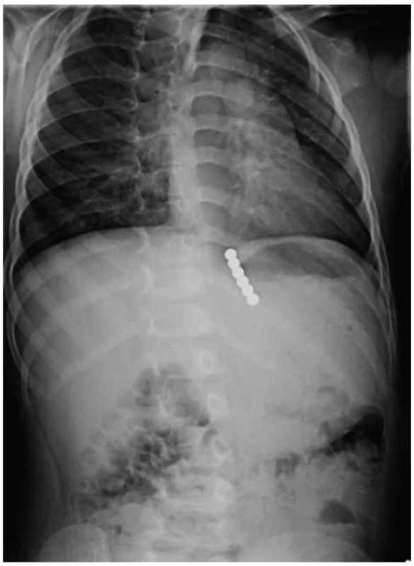 Šest magnetických kuliček, dvě v distálním jícnu,
čtyři v žaludku<br>
Fig. 2. Six magnets; two in the distal oesophagus and
four in the stomach