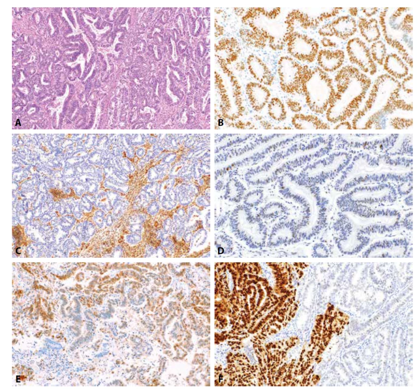 Endometroidní karcinom. Dobře diferencovaný (G1) endometroidní karcinom (HE, 100x). Nádorové buňky vykazují pozitivitu estrogenových
receptorů ve více než 90 % nádorových buněk (2B, 200x), difúzní ztrátu exprese PTEN (2C, 100x) a „wild-type“ expresi p53 (2D, 200x). Středně
diferencovaný endometroidní karcinom s fokální expresí p16 („mozaikovitý“ typ exprese) (2E, materiál z kyretáže, 200x). Středně diferencovaný
endometroidní karcinom s klonálním typem exprese p53 (2F, 200x).