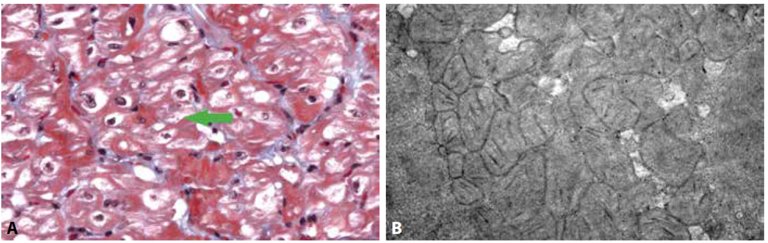 Kardiomyopatie u dítěte s vrozenou mitochondriální poruchou (mitochondriální kardiomyopatie).<br>
A: Vakuolizace kardiomyocytů s patrnými zmnoženými mitochondriemi a záchytem obřích mitochondrií (šipka) (Massonův trichrom, 400x).<br>
B: Ultrastruktura cytoplazmy kardiomyocytů s přítomností hojných atypických mitochondrií, které vykazují tvarové abnormality, paralelně uspořádané
kristy a denzní tělíska v mitochondriální matrix.