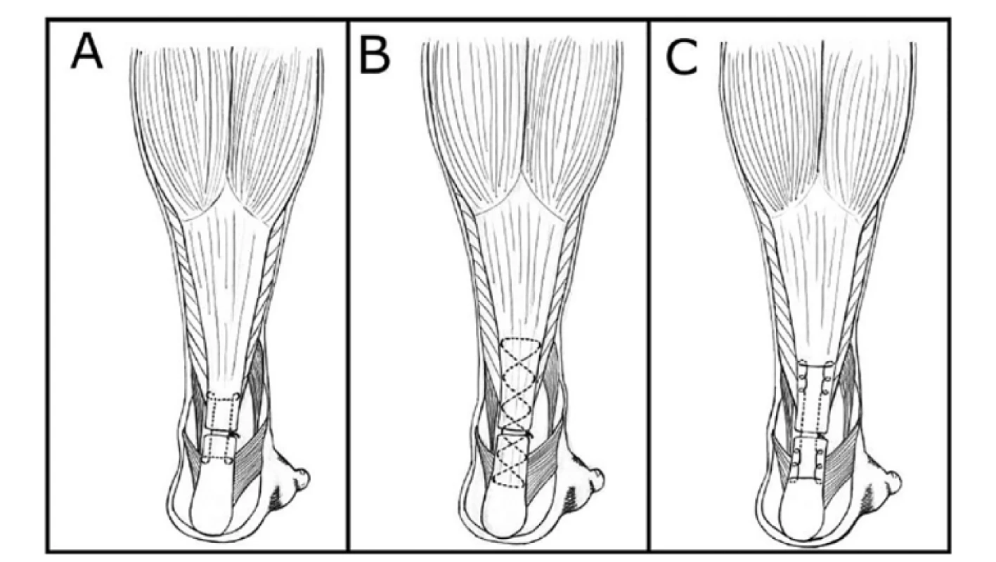 Přehled stehů Achillovy šlachy podle A – Kesslera, B – Bunnela, C – Krackowa<br>
Fig. 2: Achilles tendon sutures according to A – Kessler, B – Bunnel, C – Krackow