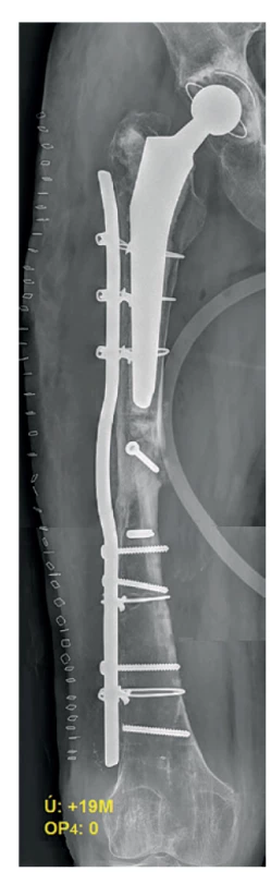 Pooperační RTG – 3. reoperace
(předehnutá dlaha)<br>
Fig. 9: Postoperative X-ray – the 3rd revision
surgery (wave plate)