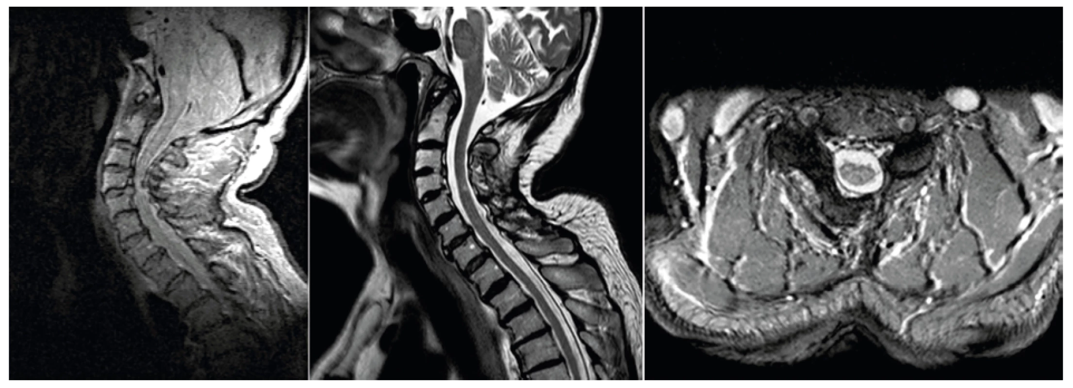 Vlevo NMR krční páteře s útlakem míchy, uprostřed a vpravo po operaci s rozšířením páteřního kanálu, přetrvává ložisko
myelopatie
