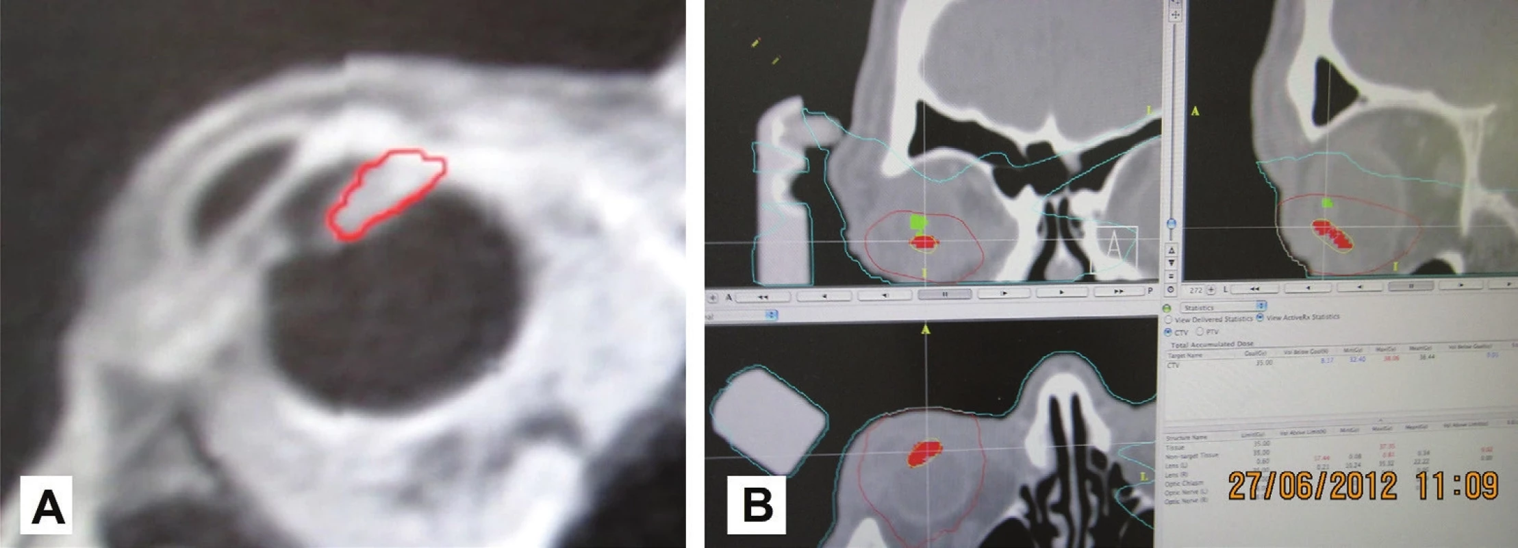 MRI image of patient with sketched tumour in the region of the corpus ciliare with outgrowth in a “forward” direction and into the chamber angle (A), and sketching of the tumour of the corpus ciliare (red colour) and lens (green colour) in the planning scheme for radiosurgical irradiation on a linear accelerator (B)