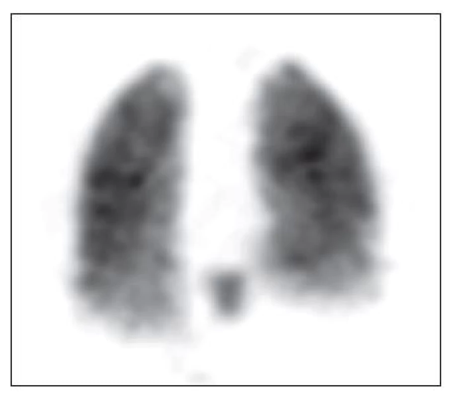3D zobrazení plicní perfuze, pohled zadní. Je patrná homogenní
distribuce perfuze obou plic a neobvyklá akumulace v dolním
mediastinu.