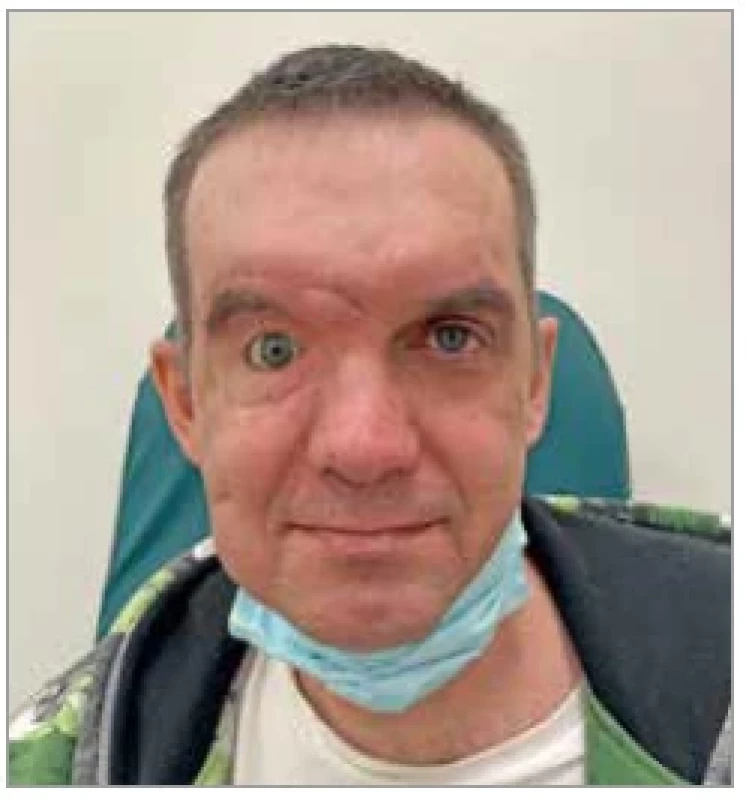 Appearance of the whole
patient’s face with final eye’s
prosthesis 6 months after the first
operation at our department.