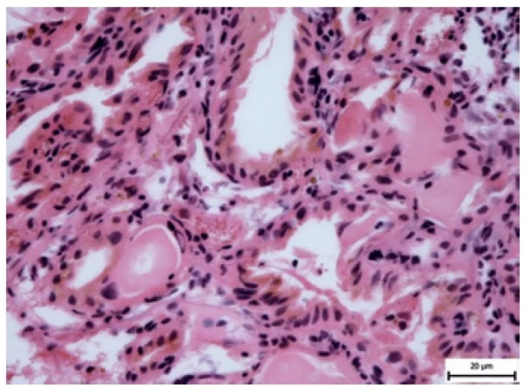 Detail nádorových buněk (HE, zvětšení 400x).