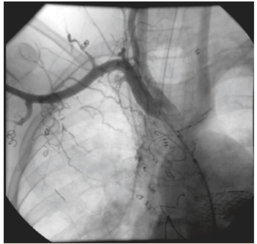 Angiografia znázorňujúca nástrek pravej podkľúčnej
tepny so 4 kolaterálami. V pravej časti hrudníka viditeľná
sieť vzájomne prepojených aorto-pulmonálnych
kolaterál (pacient 1).<br>
Fig. 1. Injection in a right subclavian artery showing 4 aortopulmonary
collateral vessels. Vascular bed of aortopulmonary
collaterals in the right hemithorax (patient 1).