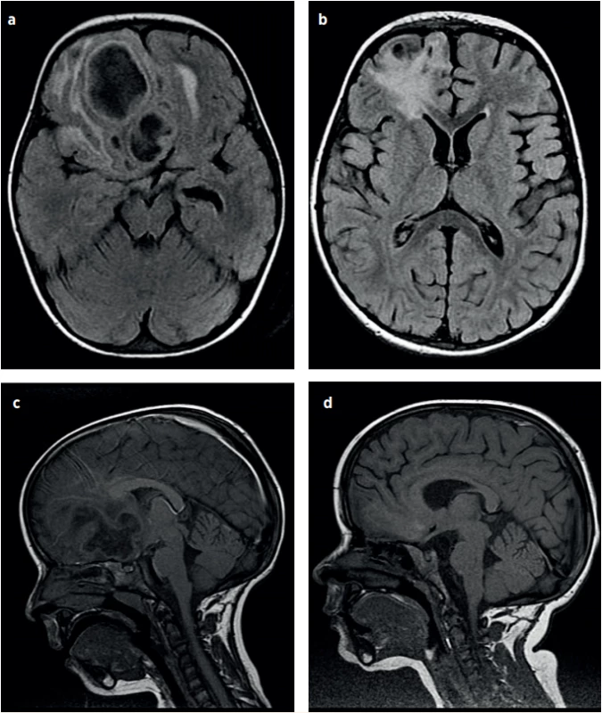 a–d (P2). NMR vyšetření hlavy, vývoj mozkového abscesu. 2. hospitalizační den (a, c); 49. hospitalizační den – výsledný stav (b, d).<br>
Fig. 6a–d (P2). Brain MRI, the brain abscess development. Day 2 of hospitalisation (a, c); Day 49 of hospitalisation – the resulting state (b, d).