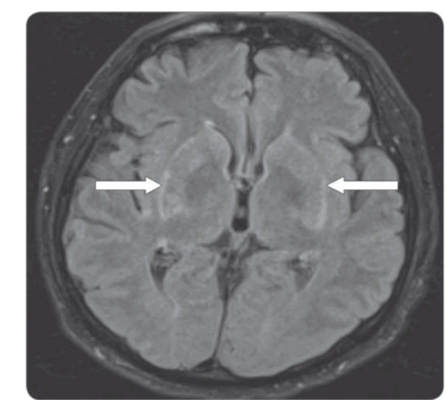 Magentická rezonance mozku zobrazující oblast bazálních
ganglií, šipky znázorňují oblast zánětlivě zvýšeného signálu.