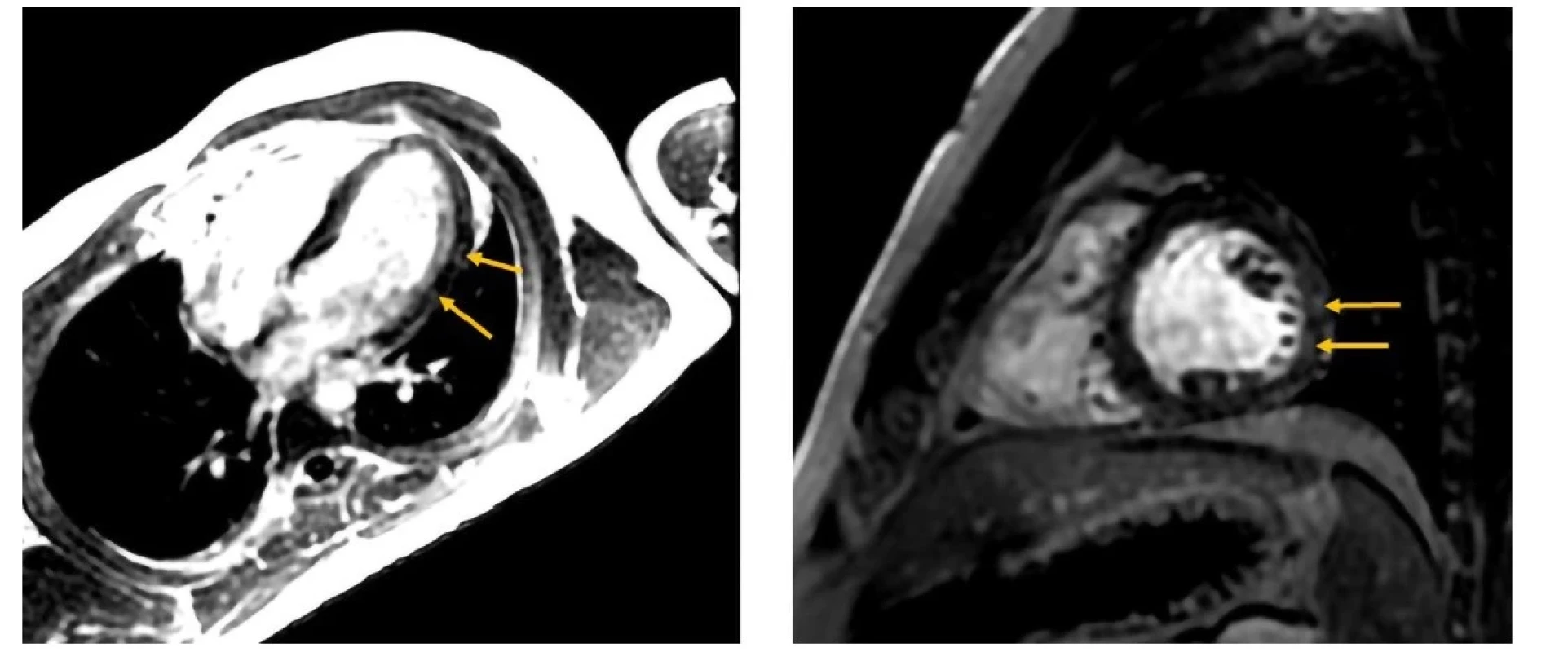 Oneskorená postkontrastná MDE (myocardial delayed enhancement) sekvencia v štvordutinovej projekcii (vľavo) a v projekcii v krátkej osi (vpravo).
Prítomné hyperintenzívne zmeny laterálnej steny – late gadolinium enhancement (šípky). Nemali korelát akútnych zmien – s primeranými hodnotami T1
a T2 máp (Klinika diagnostickej a intervenčnej rádiologie LF SZU a NÚSCH, a. s. – pracovisko magnetickej rezonancie; 30.09.2021)