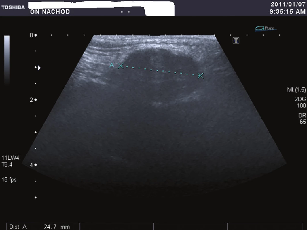 Ultrasonografie genitofemorální rýhy<br>
Fig. 1: Ultrasonography of the genitofemoral line