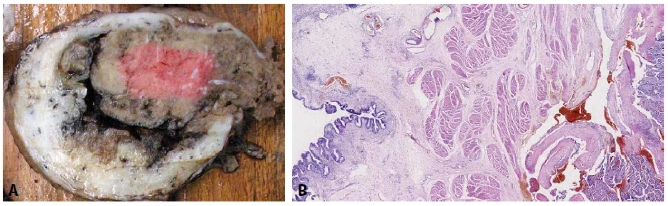 A: Placenta percreta. Prorůstání placenty přes serózní povrch dělohy. B: Placenta percreta. Prorůstání placenty do stěny močového měchýře
(grade 3b dle klasifikace FIGO, 2019) (HE, 20x).
