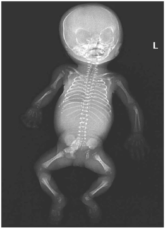 Syndrom Conradi-Hünermann, plod 24. týden, RTG. Tečkovité kalcifikace
na koncích dlouhých končetinových kostí, v oblasti carpu a tarzu, ve
spinózních a transverzálních výběžcích obratlových těl, os ischium a os pubis.