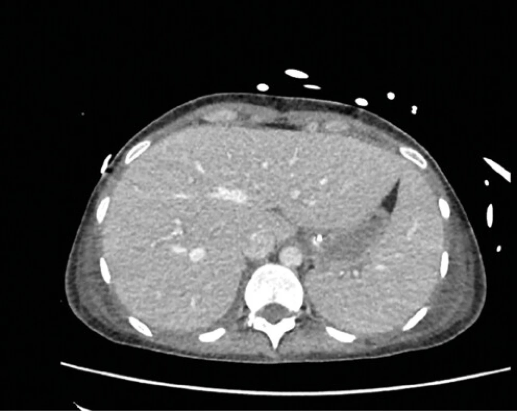 CT brucha – hepatosplenomegália, difúzny ascites