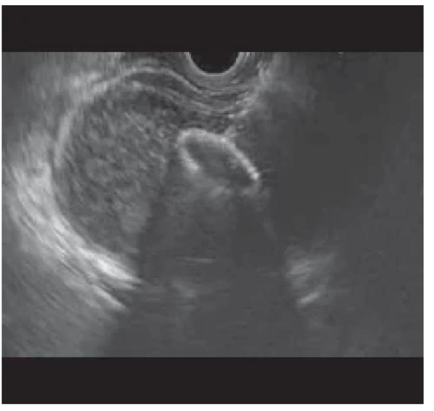 EUS zobrazení rozvinuté distální
fl ange ve žlučníku. <br> 
Fig. 2. EUS imaging of the developed distal
fl ange in the gallbladder.