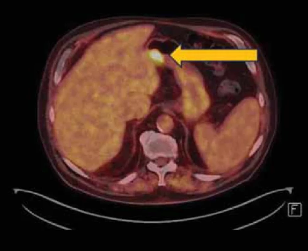 PET/CT vyšetření břicha s tumorózní expanzí žaludku.</br>Fig. 8. PET/CT examination of the abdomen with tumorous expansion of the stomach.