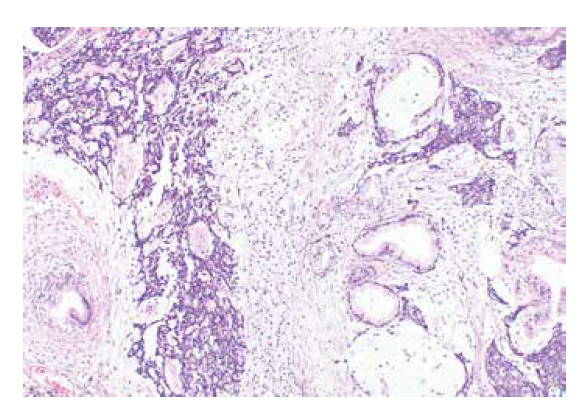 Středně diferencovaný nádor ovaria ze Sertoliho-Leydigových buněk
s heterologními elementy (barvení HE, 100x).