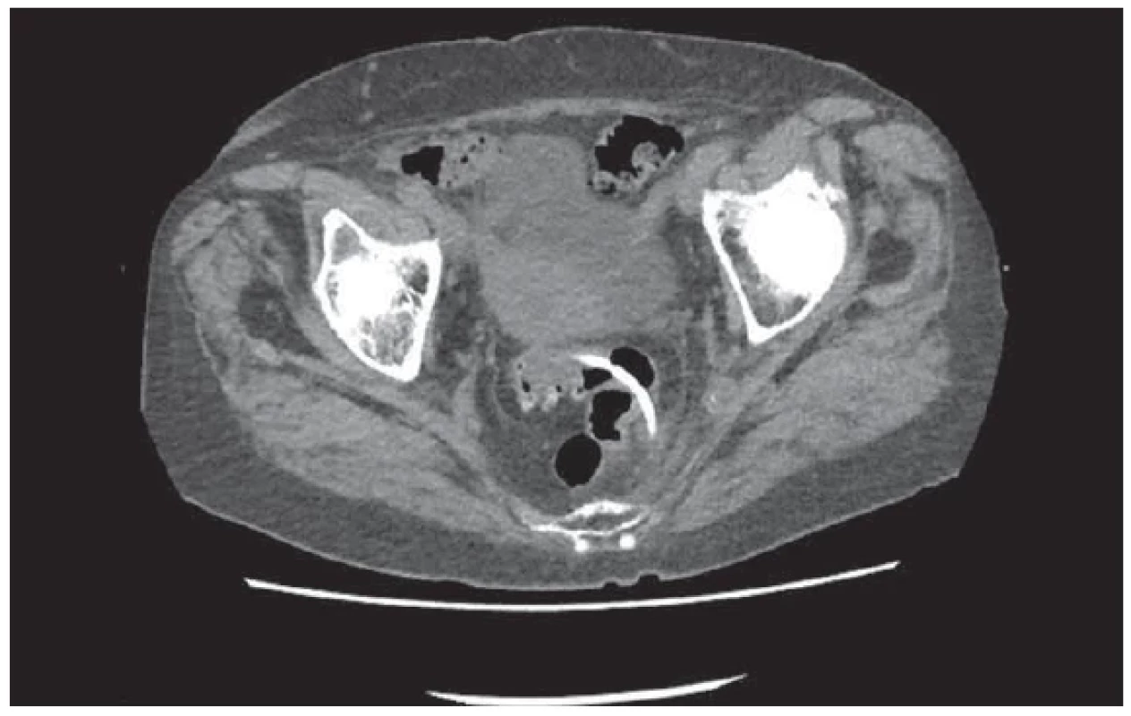 CT malé pánve: perforace sigmatu DB stentem. <br> 
Fig. 3. CT of small pelvis: perforation of sigmoid DB by a stent.