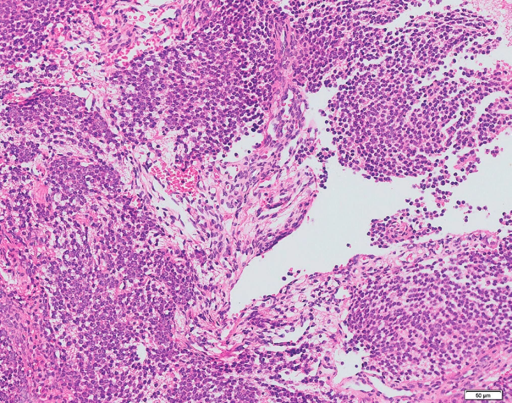 Vysoce celulární nádor tvořený splývajícími lobuly
z drobných buněk s malým množstvím cytoplazmy a okrouhlými
jádry, bez zřetelných nukleolů a prakticky bez mitotické aktivity.
Barvení hematoxylin-eosin.