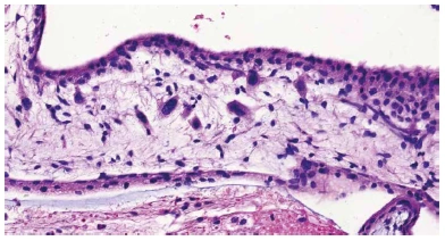 Trizomie chromozomu 18. Buňky s abnormálně velkými jádry ve stromatu
choriového klku (HE, 400x).