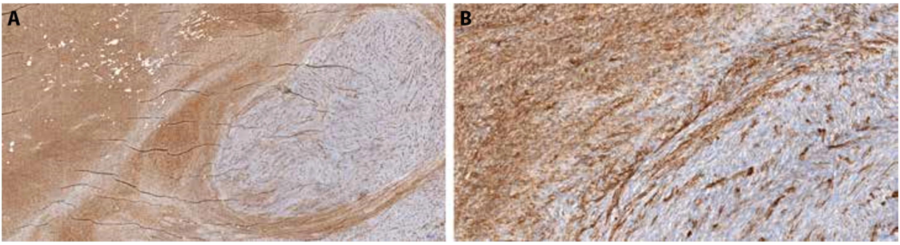 Foto z digitálního scanu histologického preparátu z radikální excize tumoru, imunohistochemie CD34. A – klasický DFSP je CD34-pozitivní, zatímco ve fibrosarkomovém nodulu je patrná pozitivita jen v cévách, 2,8x. B – detail rozhraní CD34-pozitivního klasického DFSP a negativního fibrosarkomu, 20x.