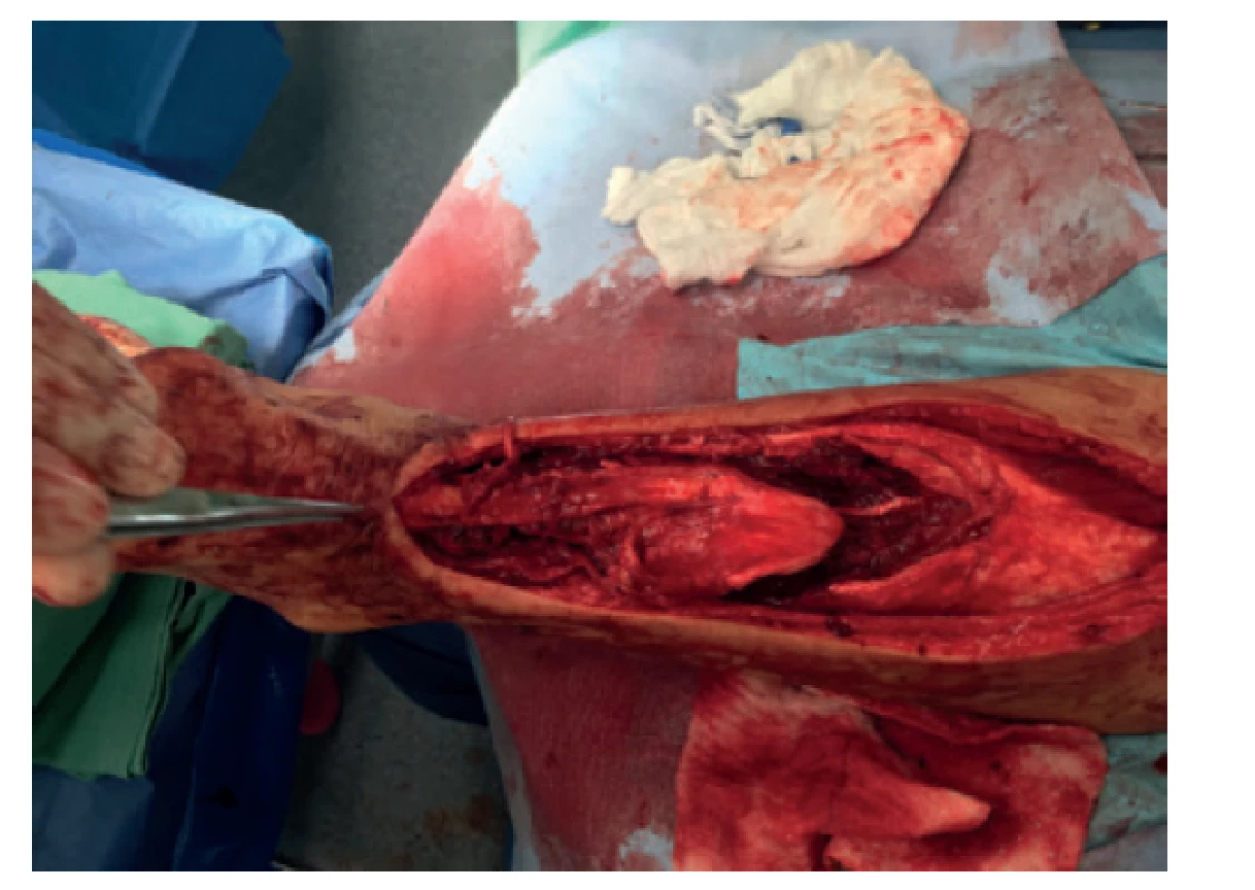 V-Y posun s možností uzavření defektu end to end
suturou<br>
Fig. 2: V-Y tendon plasty capable of closing the defect
using end-to-end suture