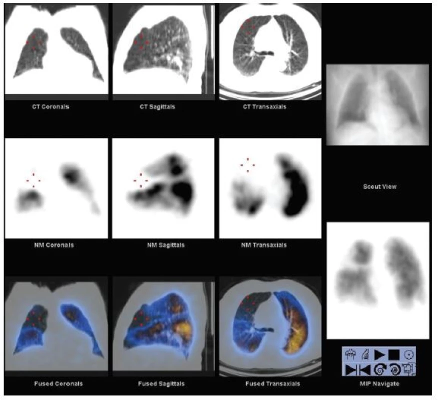 SPECT/CT plicní perfuze. Horní řada vlevo obraz LDCT, střední řada SPECT perfuze a dolní řada fúze obou obrazů. Vpravo nahoře topogram, dole 3D obraz perfuze. Z vyšetření je patrné, že perfuzní defekt je způsoben emfyzematózní bulou, nikoli embolií do plicnice.