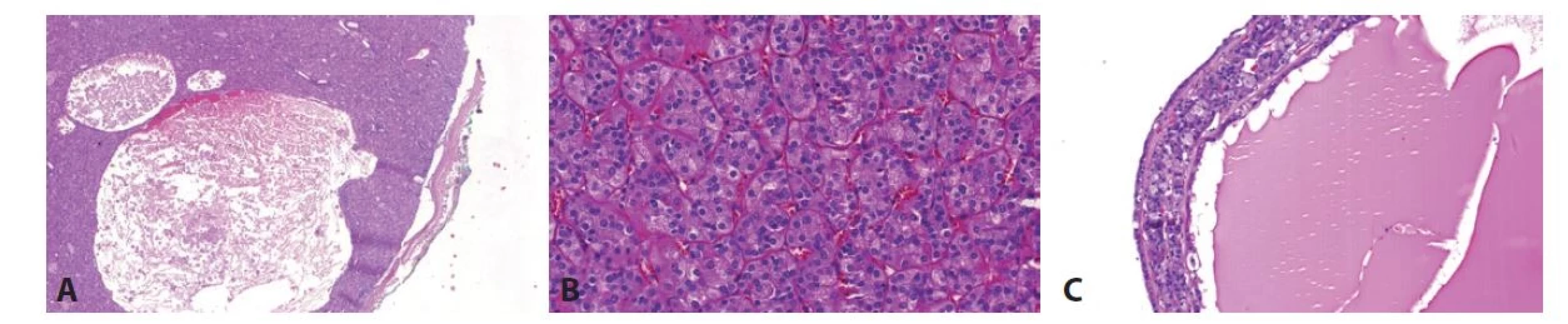 A. ESC je tumor s typickou kombinací solidní a cystické architektury. Obr. 3B. Solidní komponenta je tvořena objemnými buňkami s eosinofilní cytoplasmou
a „high-grade“ jádry. Obr. 3C. Cysty bývají vyplněné eosinofilní tekutinou, stěna cyst je složena z eosinofilních buněk, podobně jako solidní komponenta.