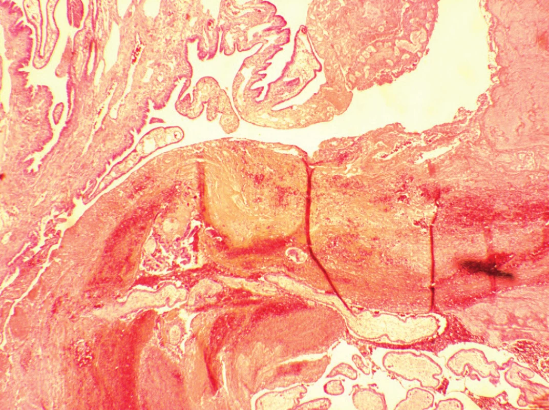 Histologický průkaz placentárních klků mezi fimbriemi
vejcovodu; barvení HE, zvětšení 20krát