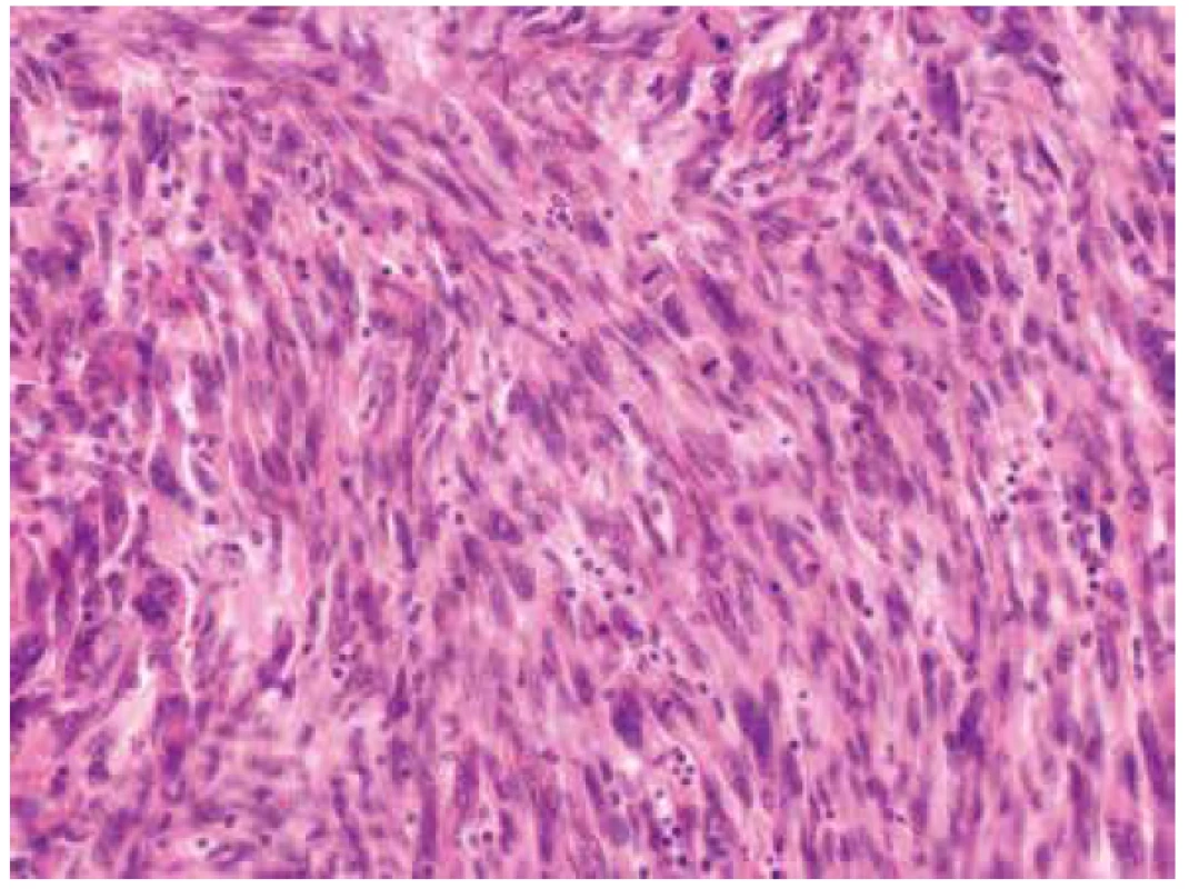 Výrazně polymorfní vřetenité buňky s atypickými doutníkovitými
jádry. Patrná je vysoká mitotická aktivita léze (HE, 400x).