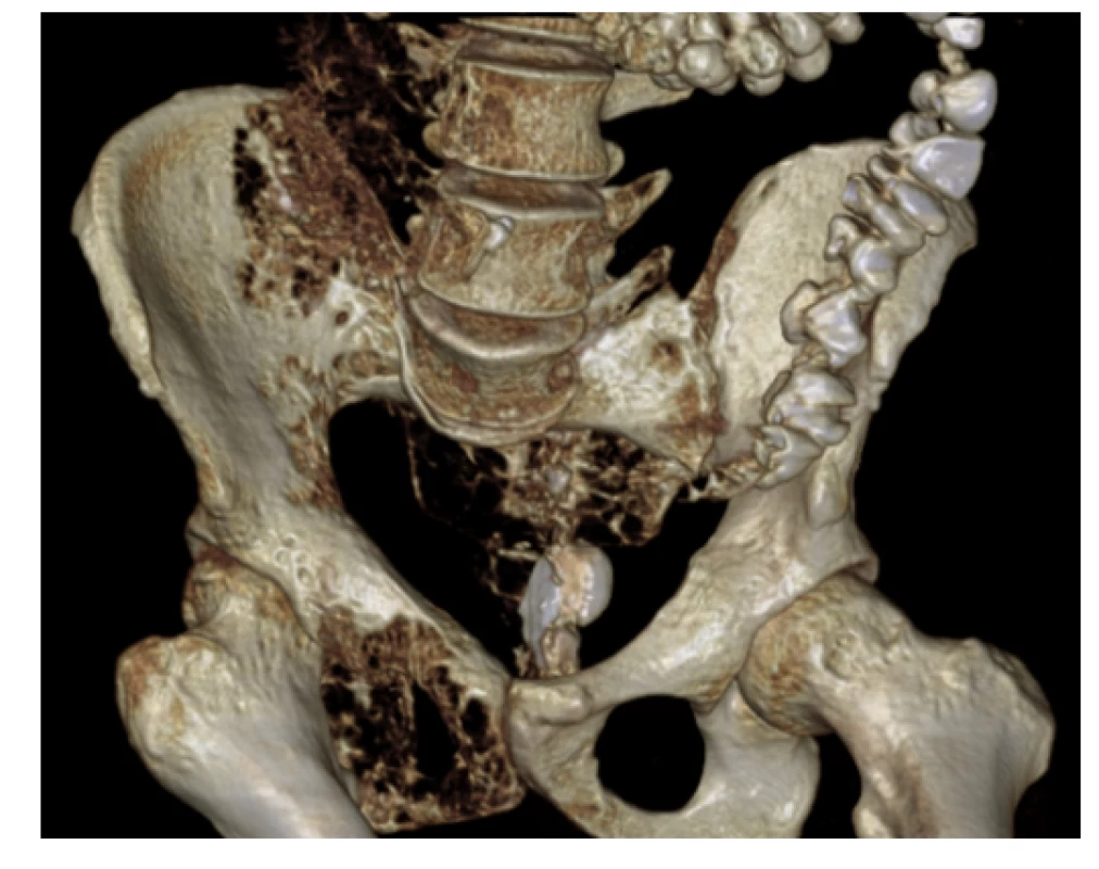 CT pánve (3D rekonstrukce) – osteolytické změny pánve vpravo