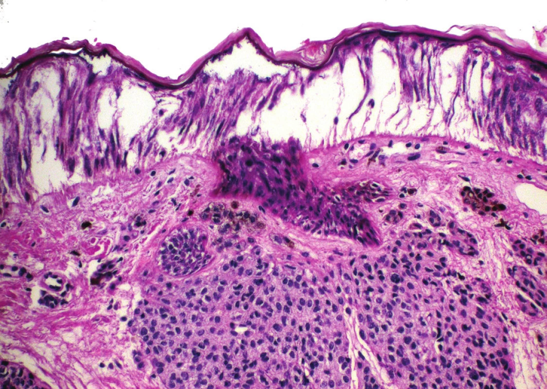 Fulgurační artefakt u melanocytárního névu – odloučení
epidermis s protažením jader keratinocytů