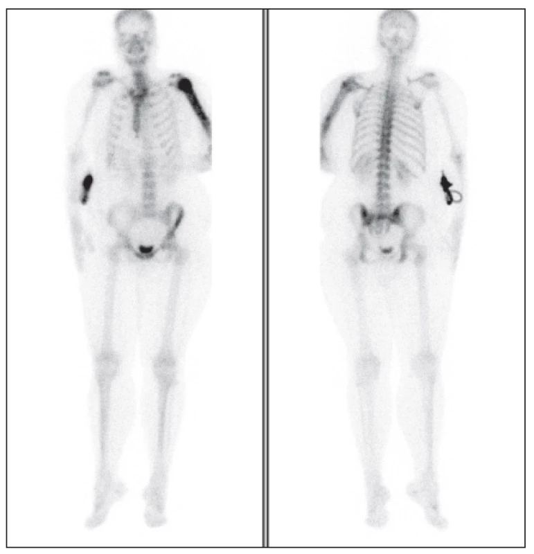 Na celotělovém snímku je aktivita akumulována zvýšeně v levé pažní kosti
s maximem v hlavici. Ostatní skelet je bez ložiskových změn.