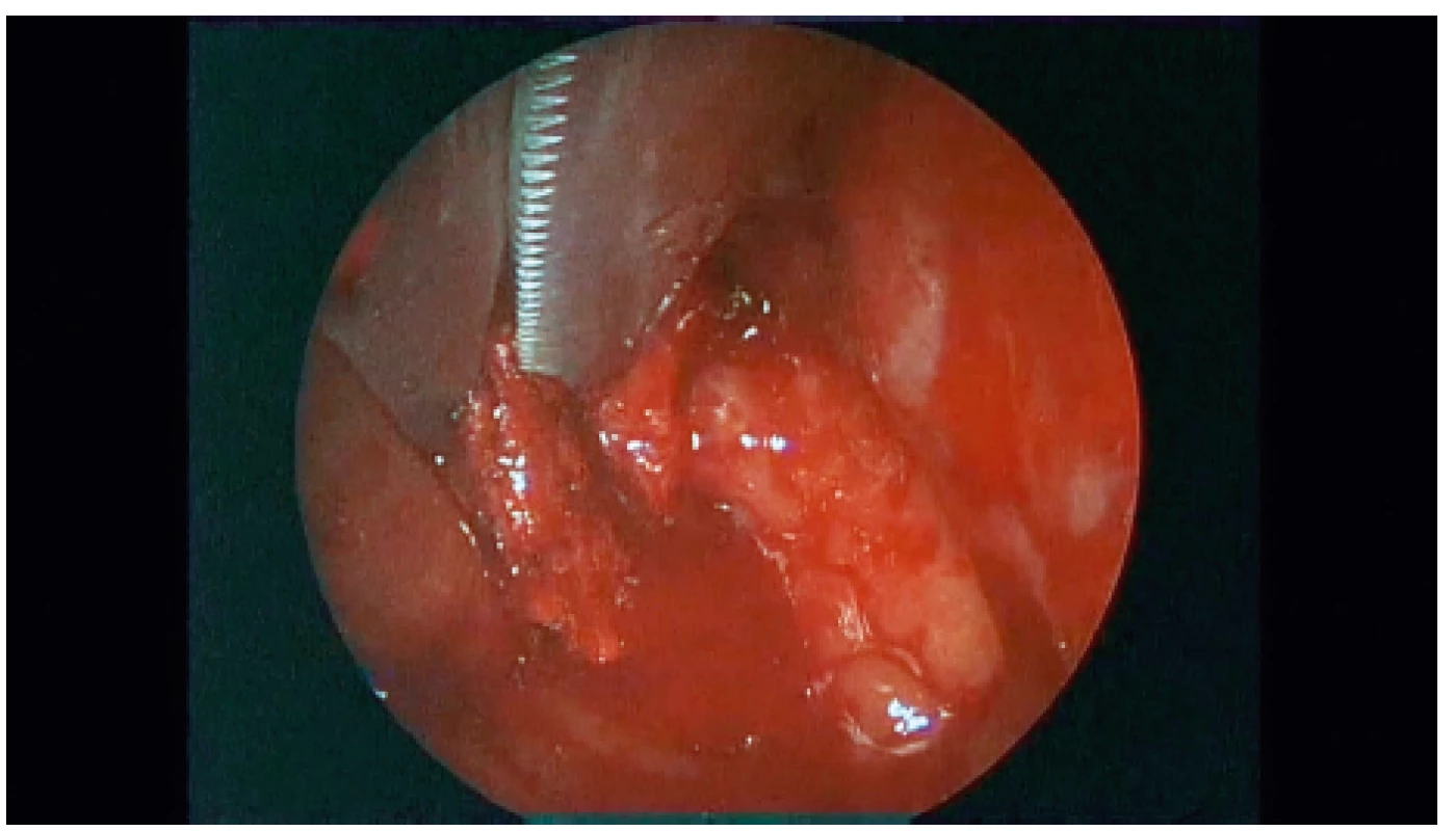 Pohľad endoskopom cez transmaxilárny koridor, nožnicami
prestrihávané cudzie teleso.