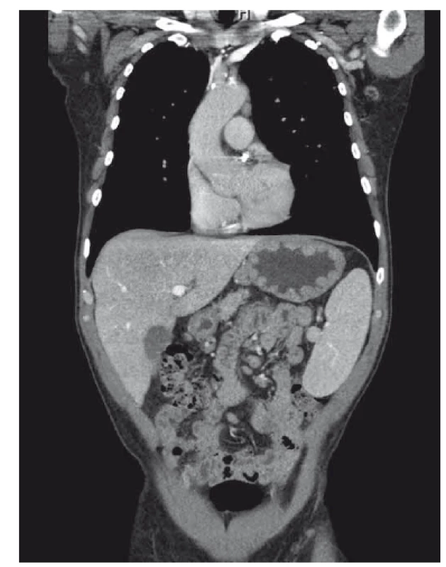 CT obraz zesílené stěny žaludku, hepatosplenomegálie,
abdominální lymfadenopatie, sagitální řez.
Fig. 1. CT scan of thick gastric wall, hepatosplenomegaly,
abdominal lymphadenopathy, saggital.