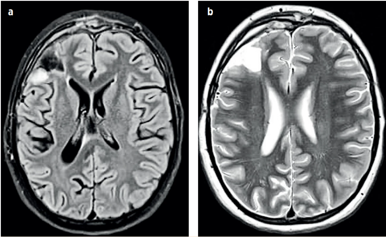 a, b (P1). Kontrolní NMR vyšetření hlavy v odstupu čtyřech měsíců – výsledný stav. (Za laskavého přispění MUDr. Pavla
Rejtara)<br>
Fig. 5a, b (P1). The brain MRI after four months – the resulting state. (Credit Dr. Pavel Rejtar)