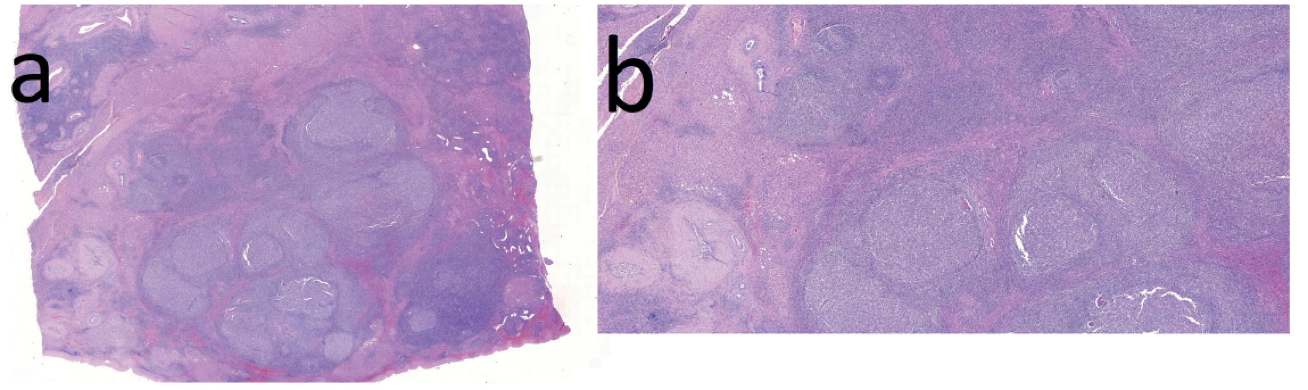 Histologické řezy v barvení Hematoxylin/Eosin: 4a − přehledné zvětšení (histotopogram). Většinu řezu zaujímá folikulární
lymfoidní hyperplazie, dále jsou patrny části jaterního parenchymu a proliferace cév a žlučovodů; 4b − při větším
zvětšení jsou patrny lymfoidní folikuly s objemnými zárodečnými centry a úzkými plášti, naznačená nodularita okolního
jaterního parenchymu se steatózou a zmnožené žlučovody<br>
Fig. 4. Histology cuts in Hematoxylin/Eosin staining: 4a − low magnification; follicular lymphoid hyperplasia is seen in
a major part of the field; the rest consists of normal liver parenchyma with vascular and bile duct proliferation; 4b − closeup;
lymphoid follicles with large germinal centres; the surrounding parenchyma is nodular and steatotic with an increase
in the number of bile ducts
